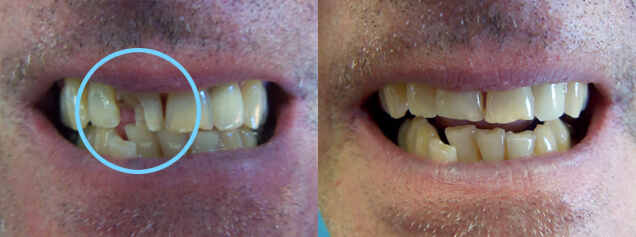 Bonding on tooth #8
