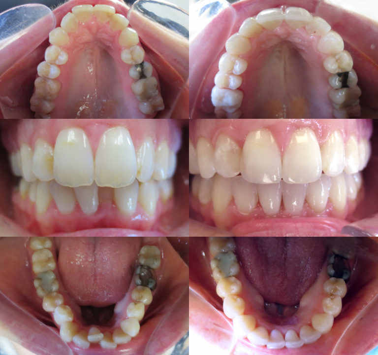 Invisalign Sparta NJ