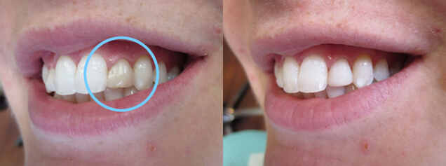 Veneer on #10