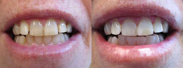 zoom-whitening