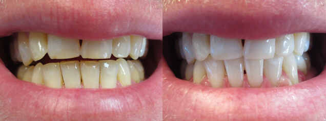 Zoom Whitening